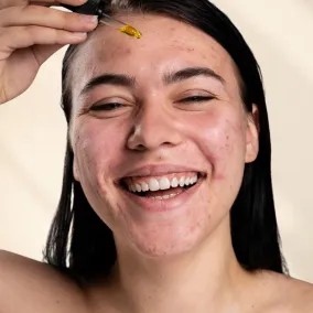 Blemish-prone skin